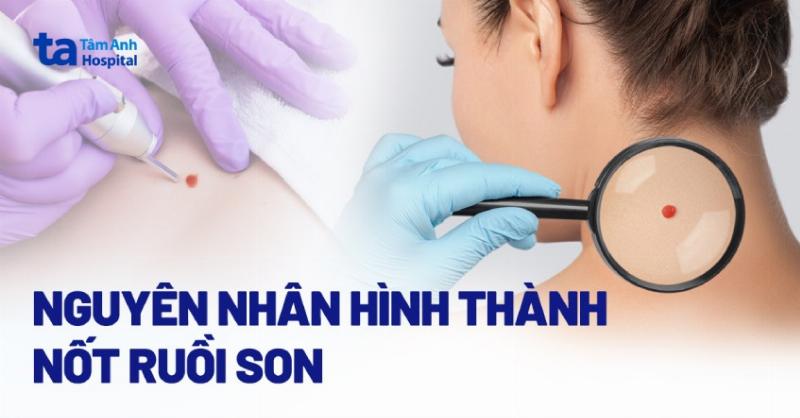 Khám phá ý nghĩa các dạng nốt ruồi trên vai trái: son, đen, chìm, nổi