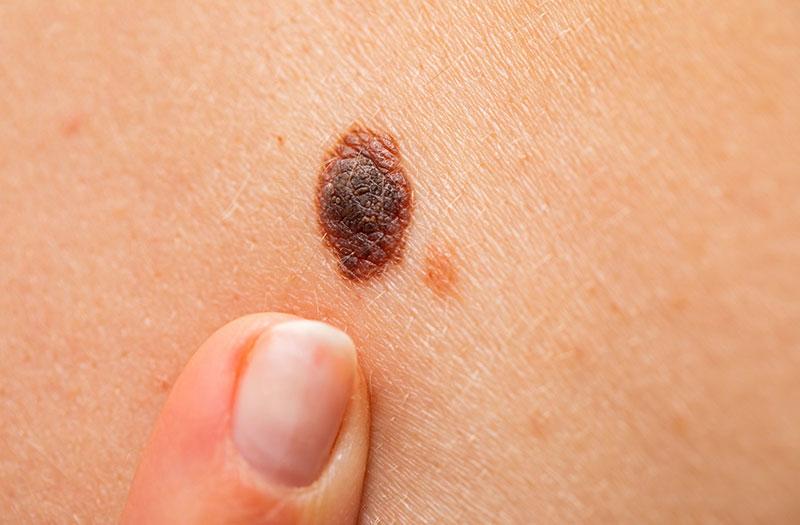 Hướng dẫn phân biệt nốt ruồi tốt và xấu trên vai trái dựa trên đặc điểm