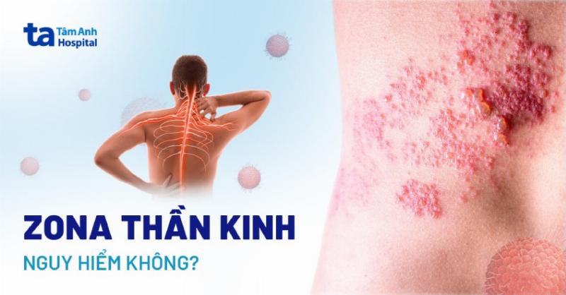 Canh bac si dang tham kham vung da bi anh huong boi benh an dau sau zona
