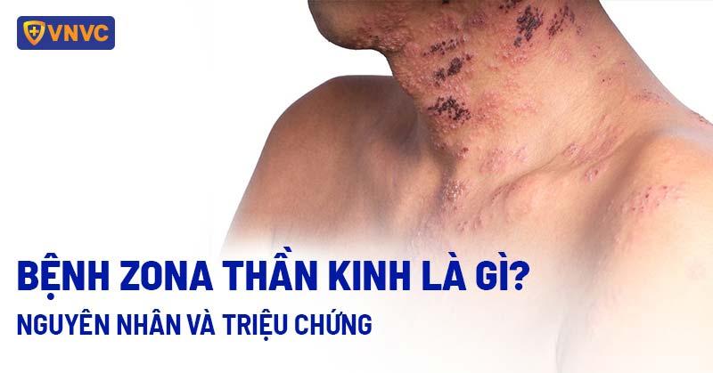 Hinh anh nguoi benh dau sau zona dang thuc hien mot hoat dong binh thuong
