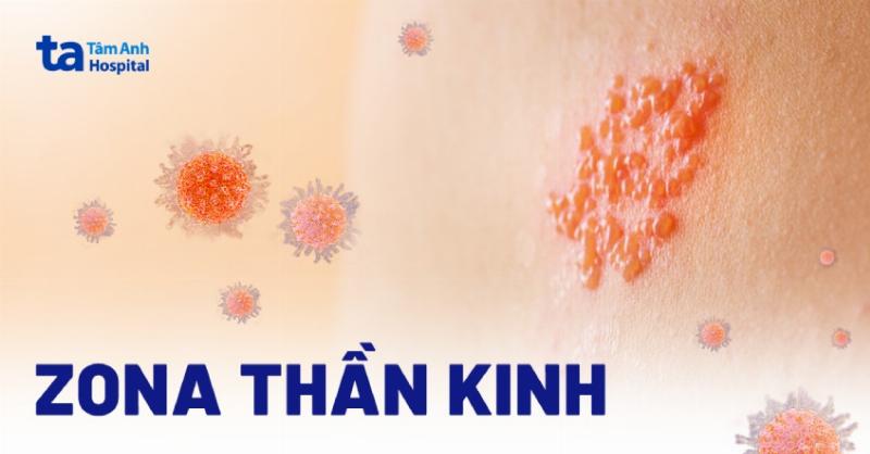 Hinh anh virus zona gay ton thuong day than kinh dan den benh an dau sau zona