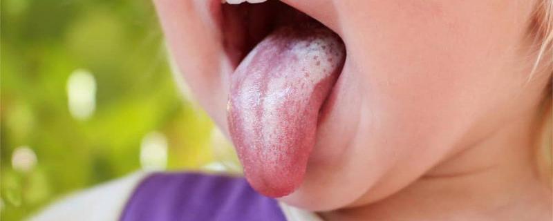 Nhiễm Nấm Candida Trong Miệng