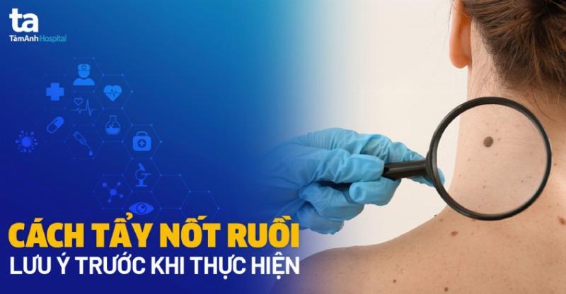 Nốt ruồi theo vùng trên mặt đàn ông