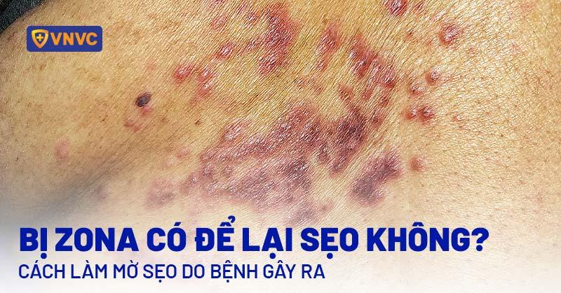 Mo hinh cac phuong phap ket hop cho benh an dau sau zona