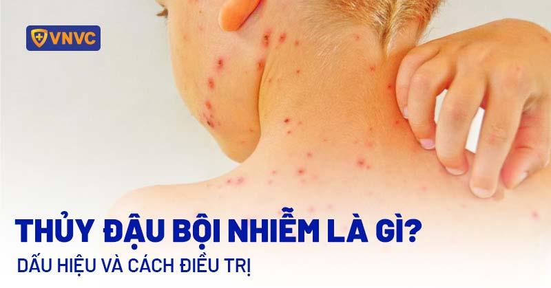 Hinh anh minh hoa vac xin phong ngua benh an dau sau zona